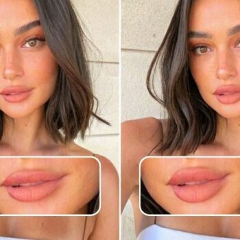 Find Out What Lip Shape Suits You? Use A Lip Filler Simulator